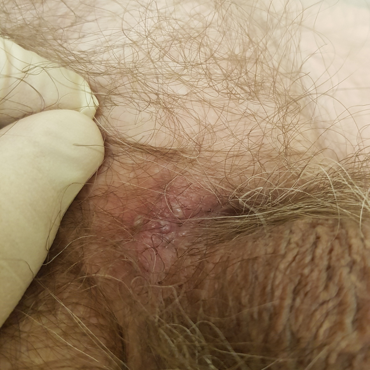 герпес в основании члена герпес в основании члена