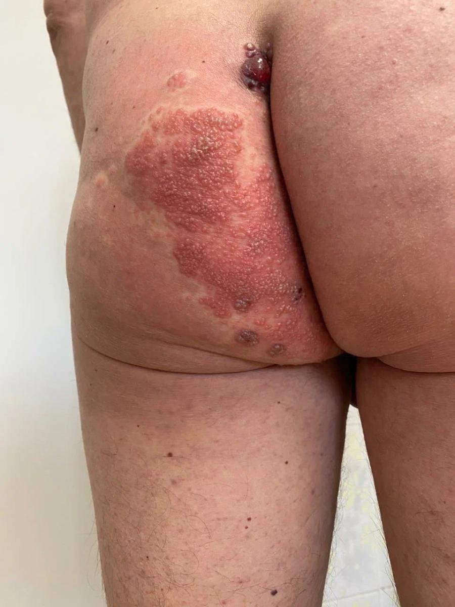 высыпания на спине герпес