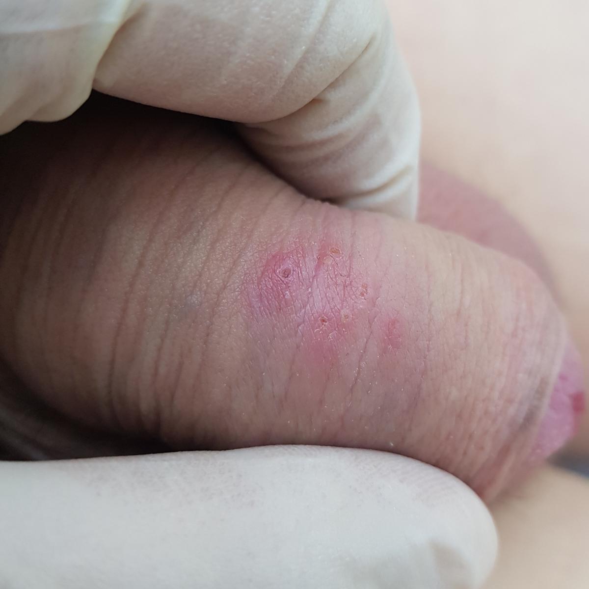 Герпес на члене Герпес