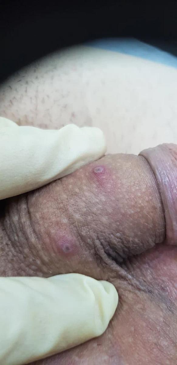 Пустулы и язвы Язвы и пустулы после заживления герпеса