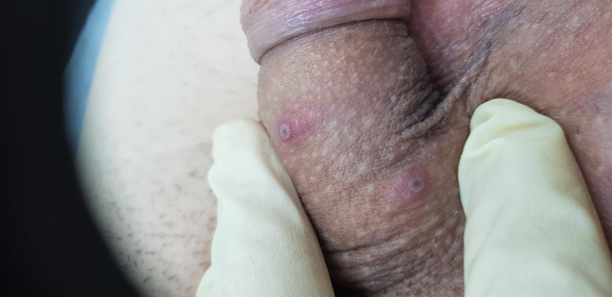 Проявления герпеса 1 типа