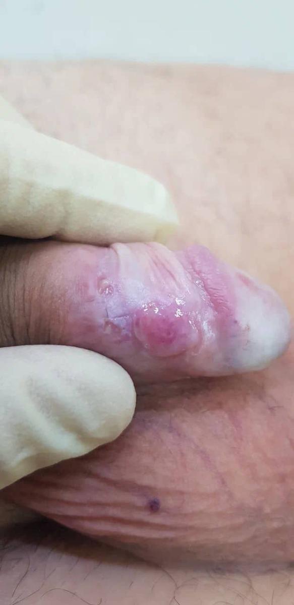 высыпания на коже половых органов 