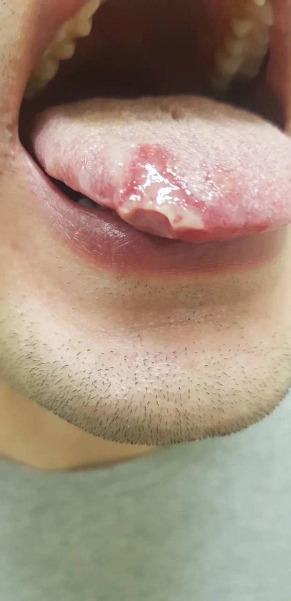 венерические заболевания основные ЗППП