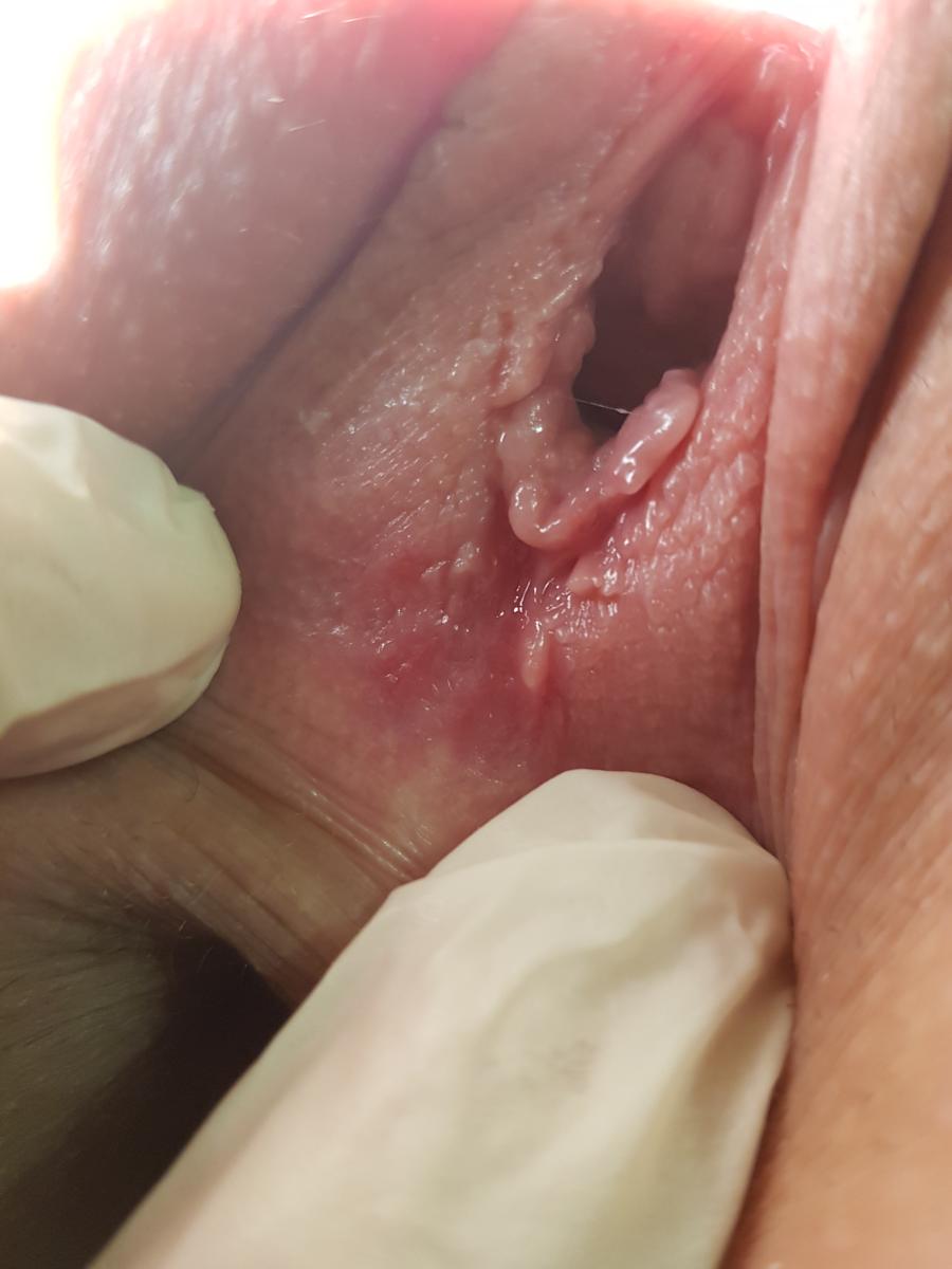 герпетические везикулы