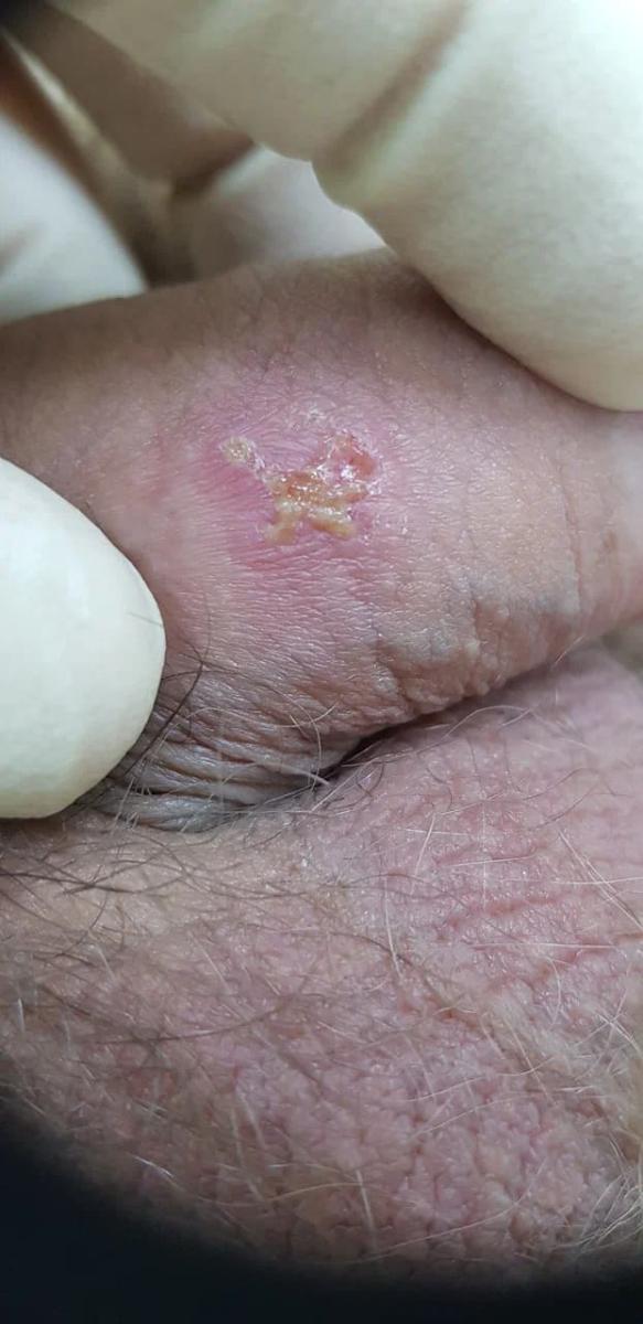 герпес и впч