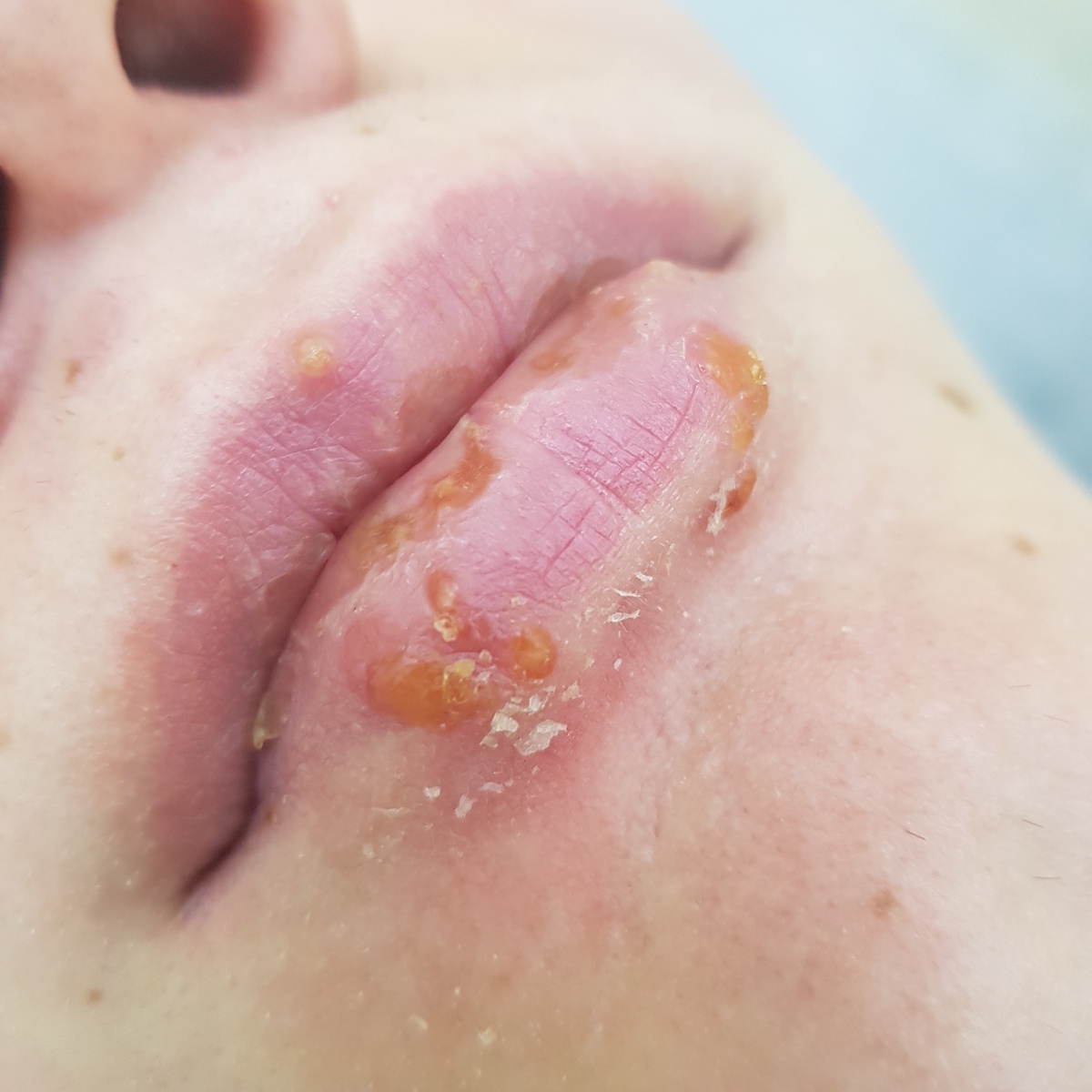 герпес на губах герпес на губах