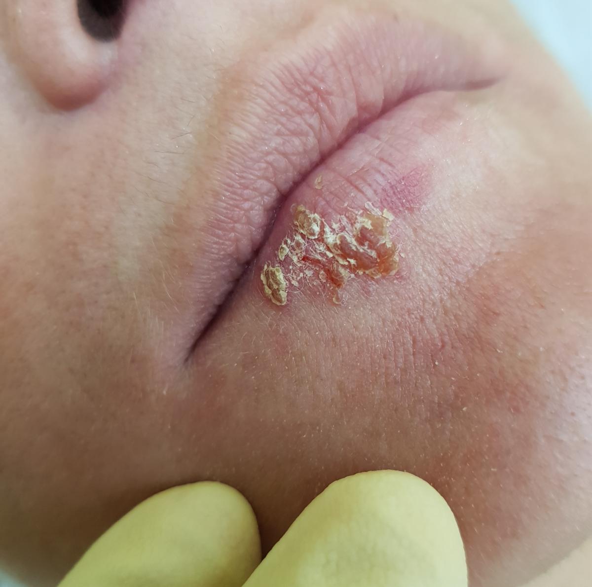 лабиальный герпес герпес на губе