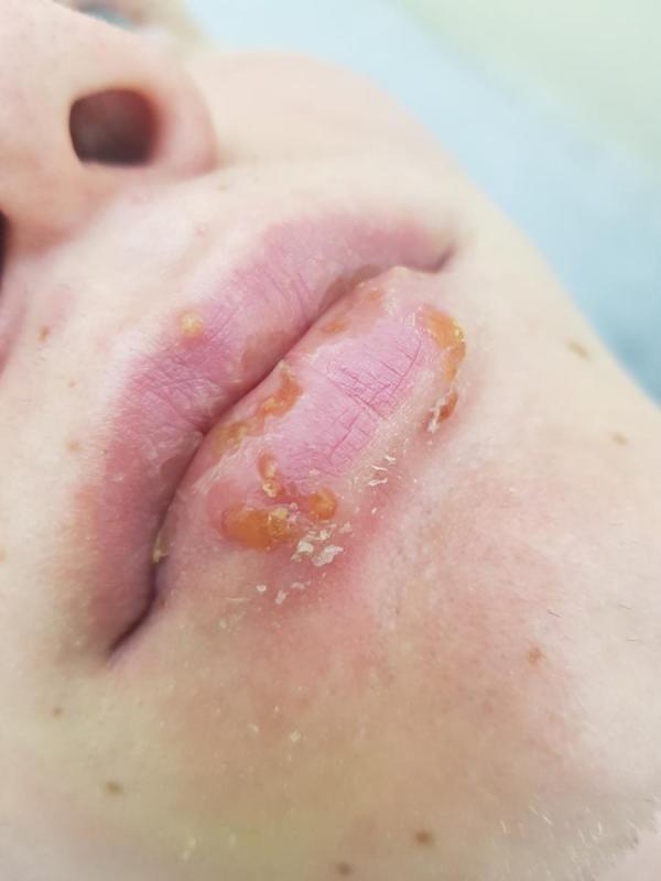 герпес на губах герпес