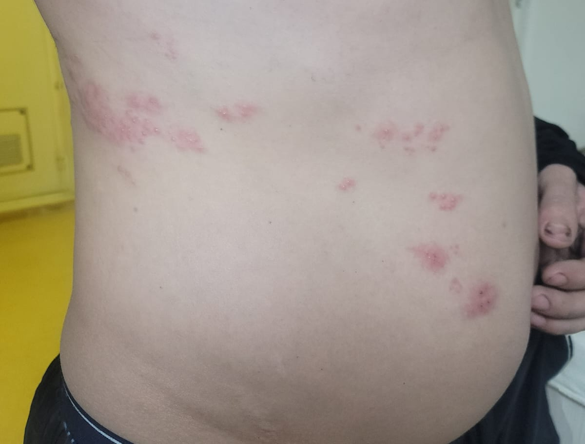 герпес на теле герпес на теле