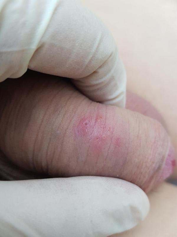 проявления герпеса заражение генитальным герпесом