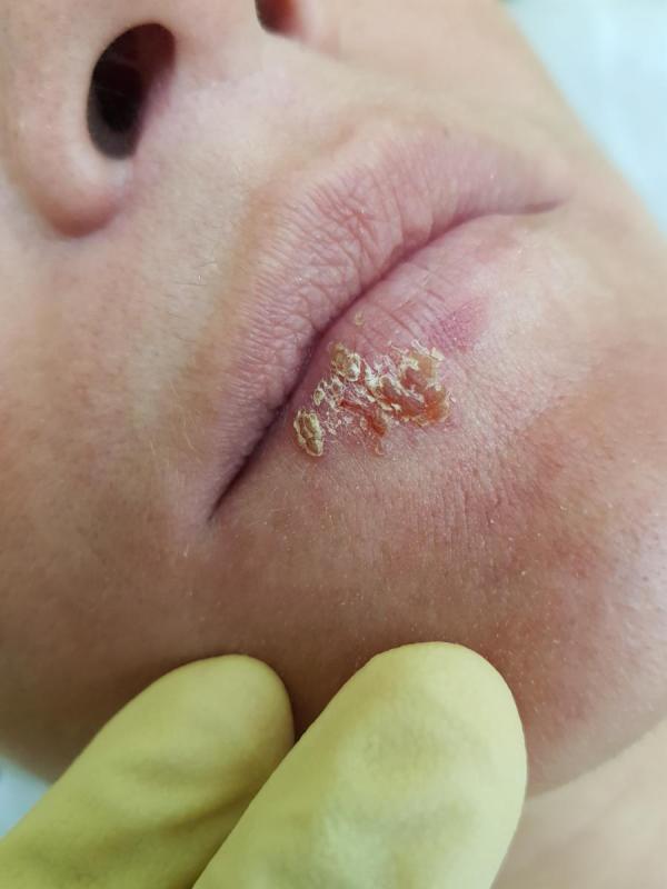 заразиться через поцелуй? заразиться