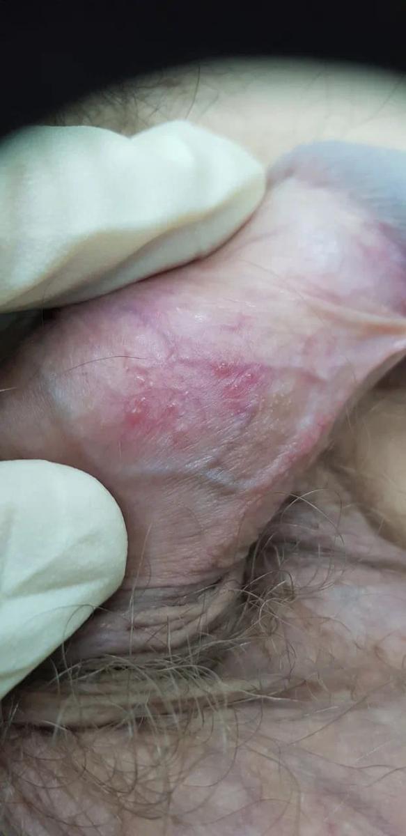 Пустулы и язвы Язвы и пустулы после заживления герпеса1