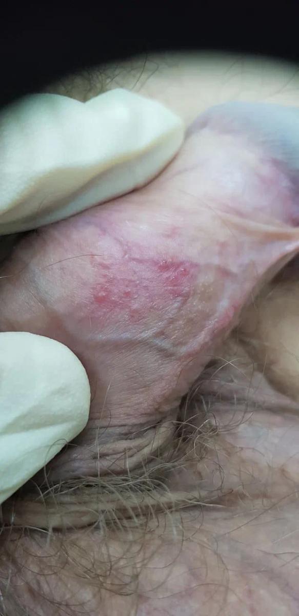 герпес рецидив