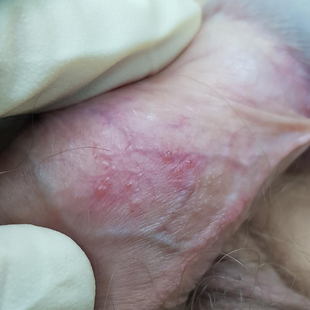 генитальный герпес покалывание при герпесе на члене