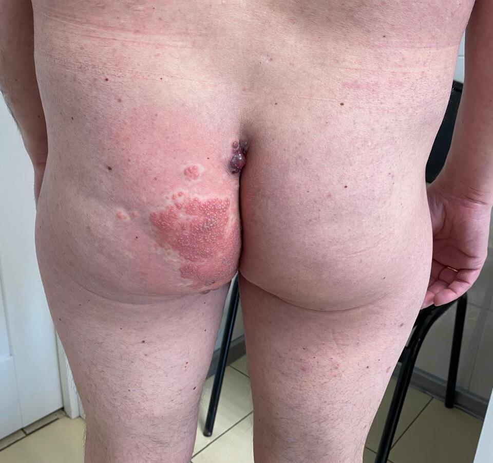 герпес заднего похода герпес в области ануса