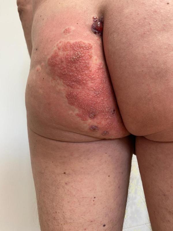 половой контакт половой путь заражения генитальным герпесом