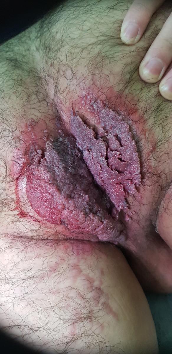 Кондилома Бушке