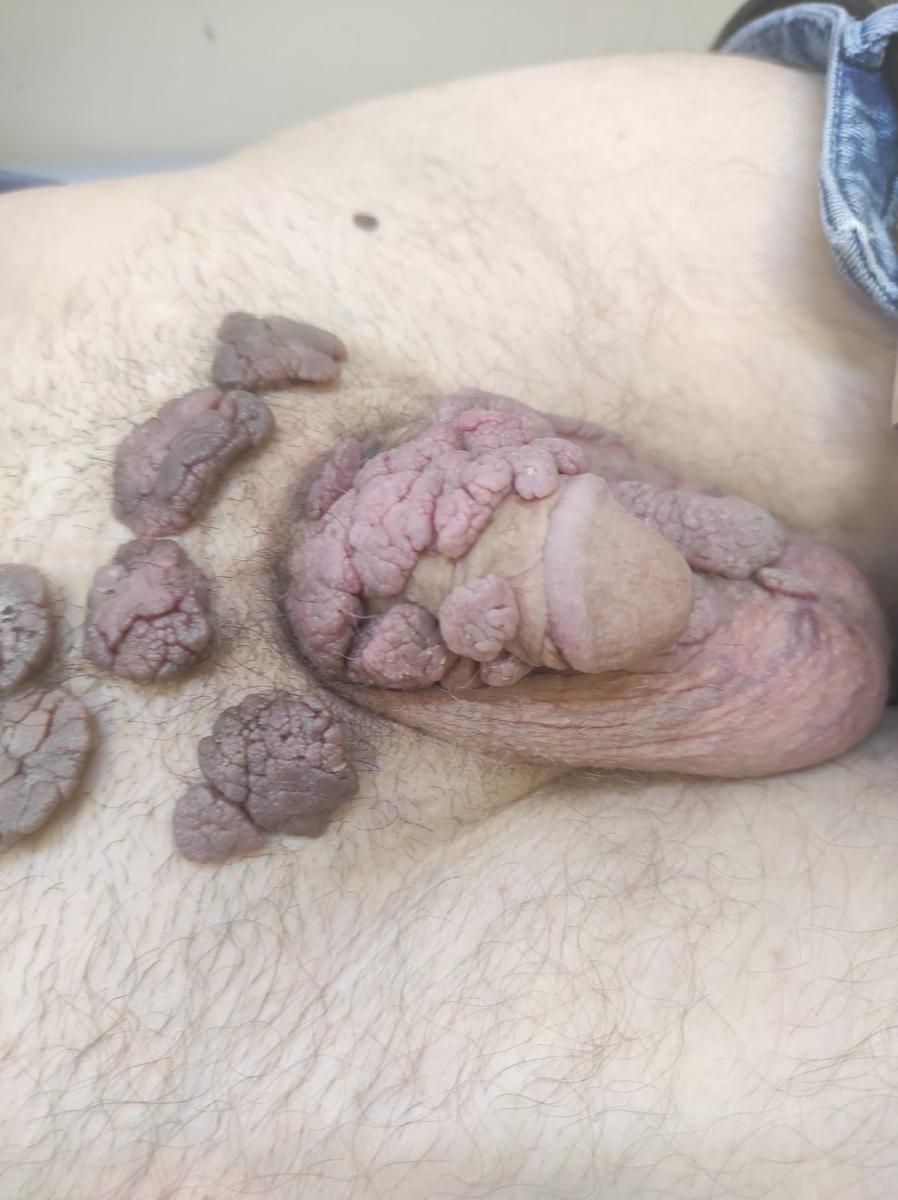 гигантские кондиломы