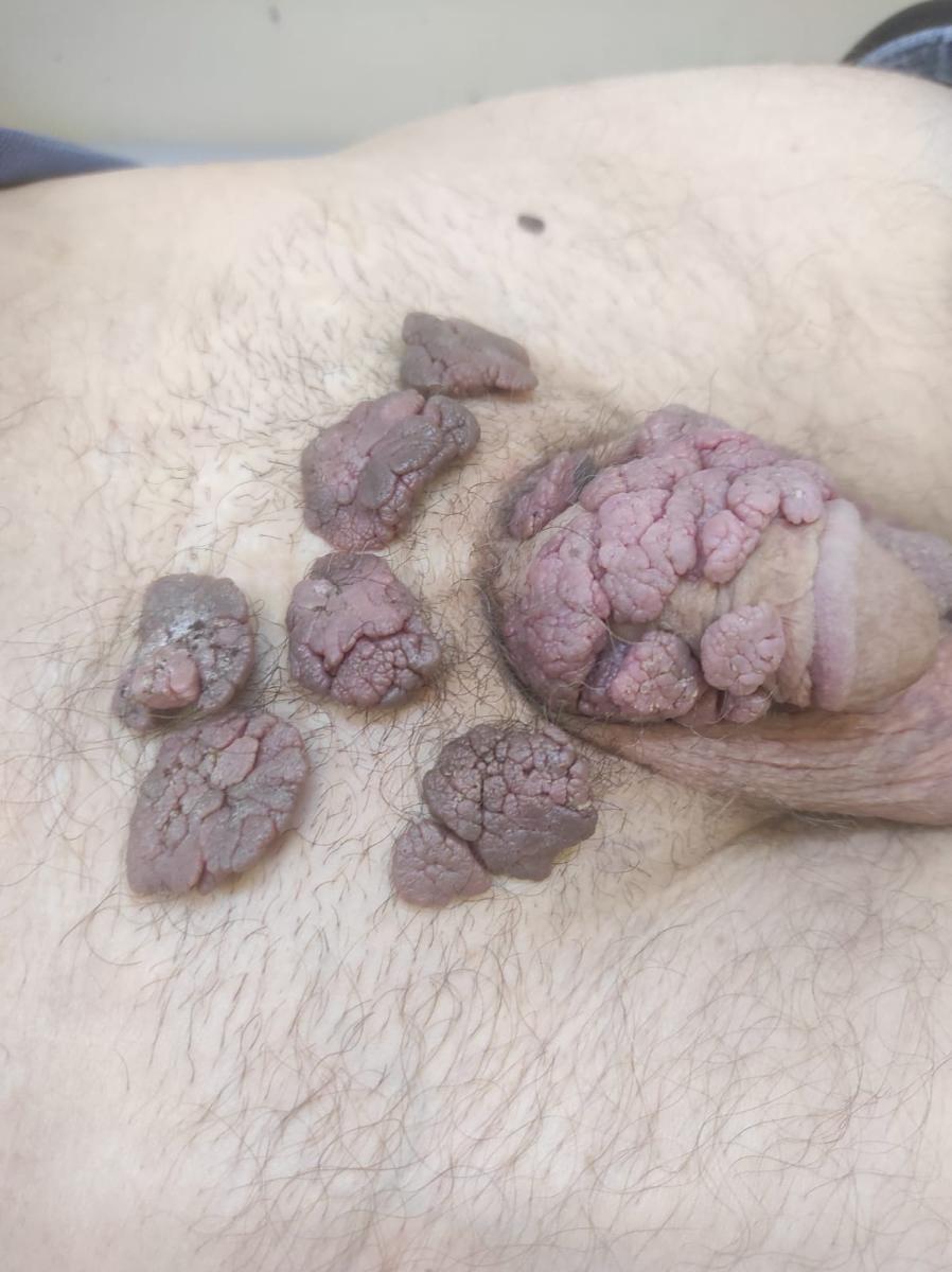 кондиломы члена