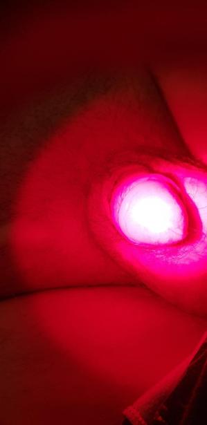 фотодинамика при гипермеланозе головки фотодинамика