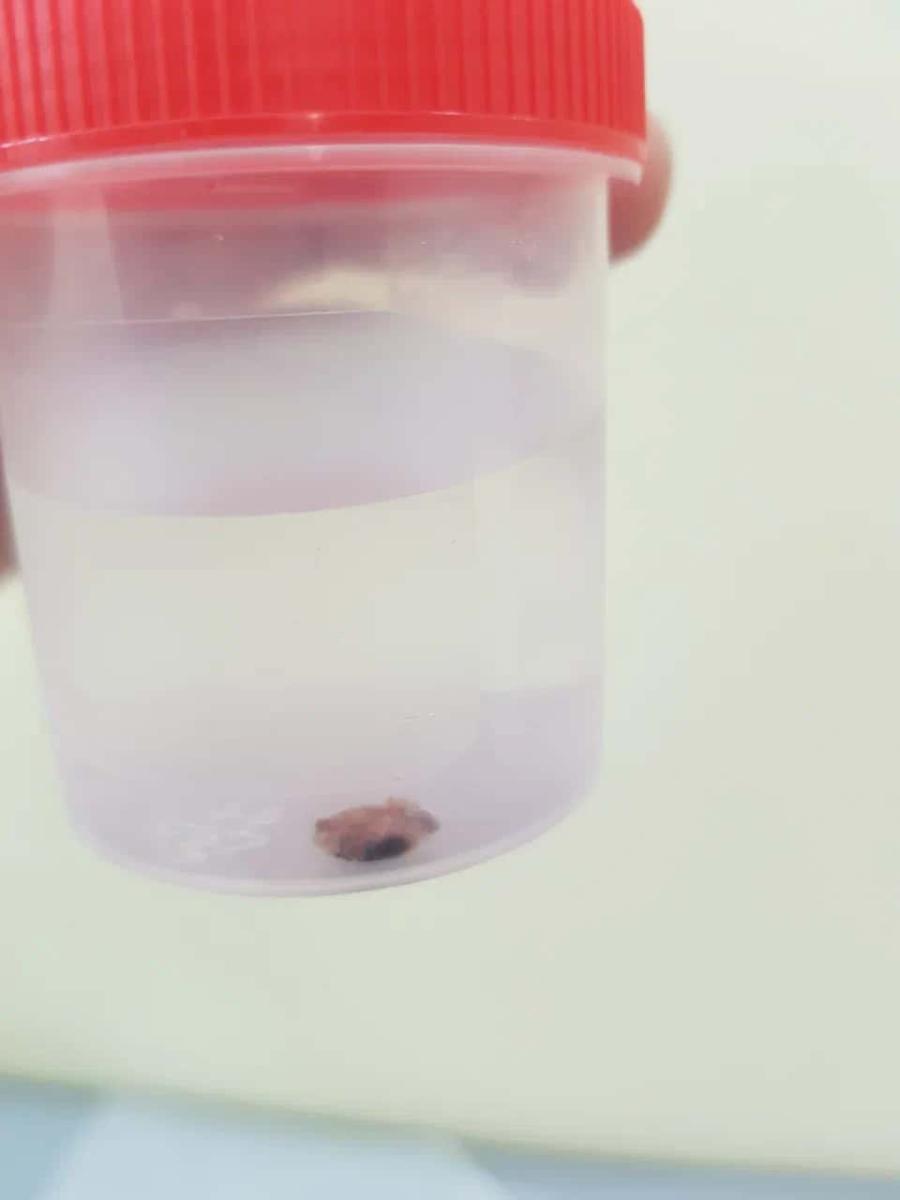 гистология родинки