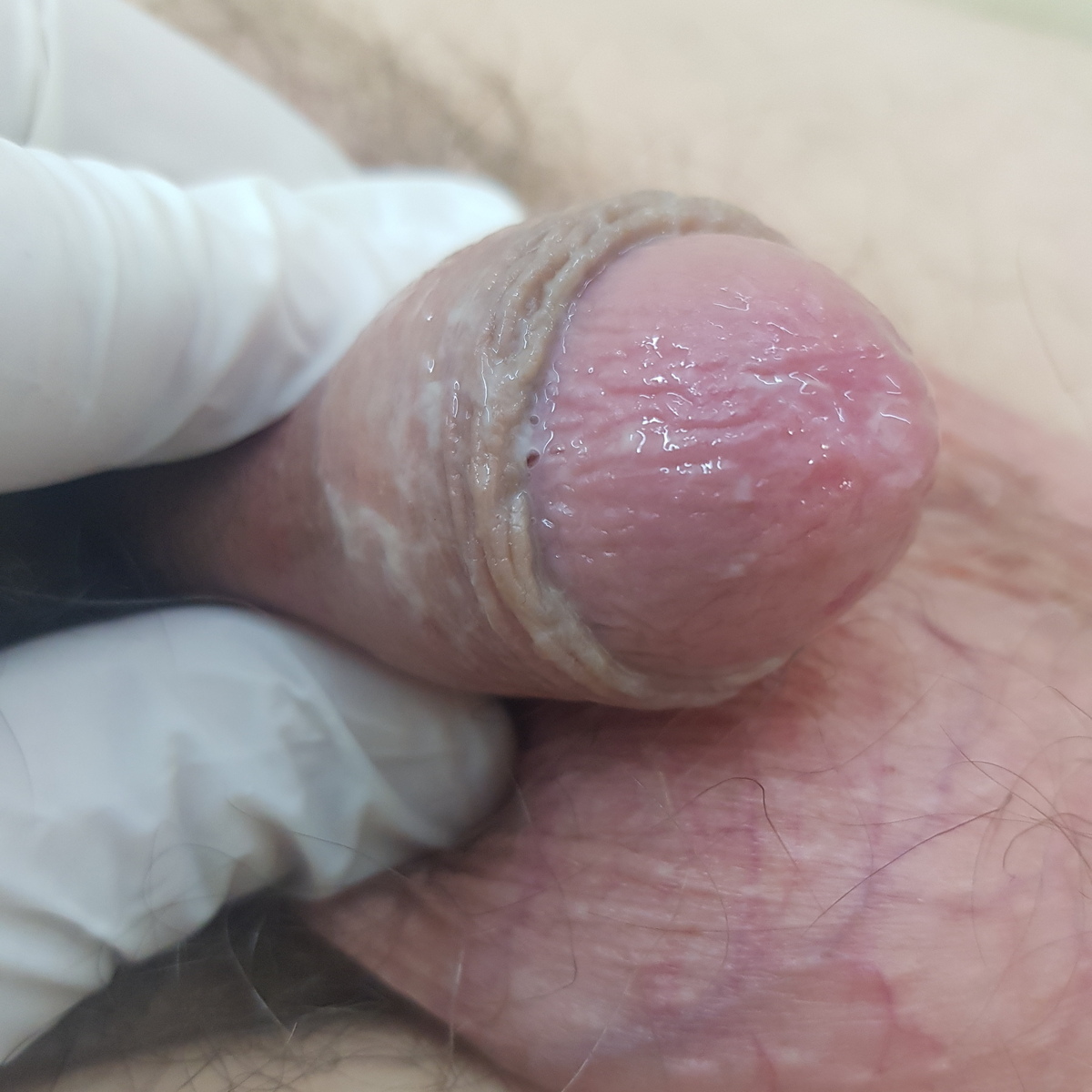 гной при гонорее гной при гонорее