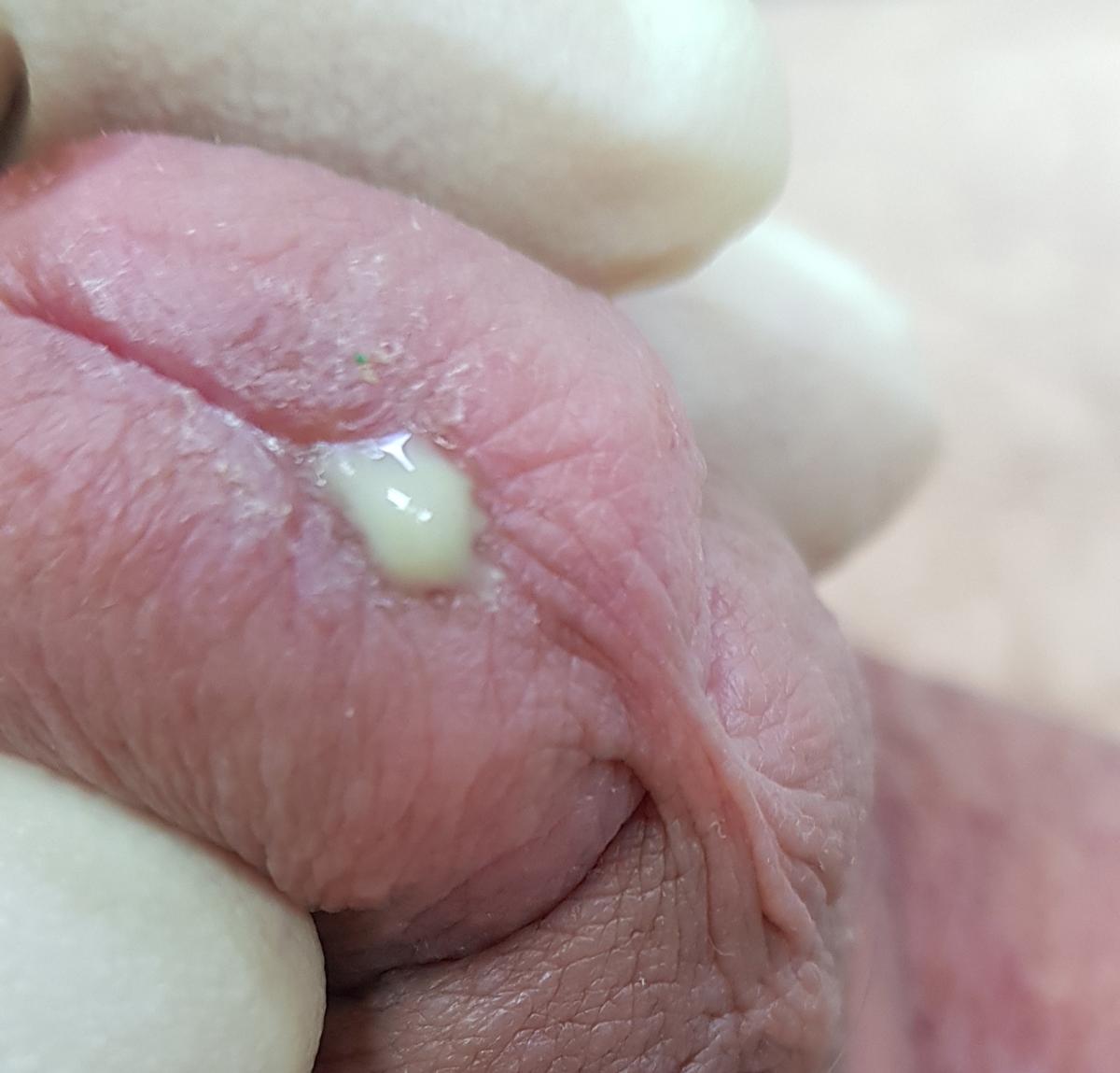 гонорея гонорея симптомы