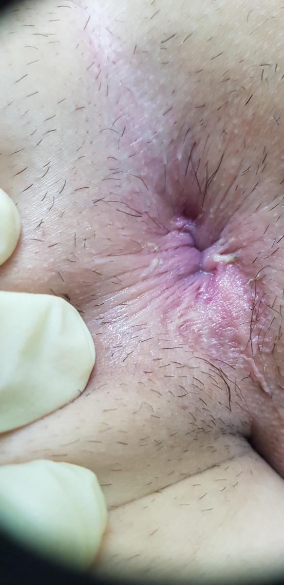 Заражение через общие средства гигиены