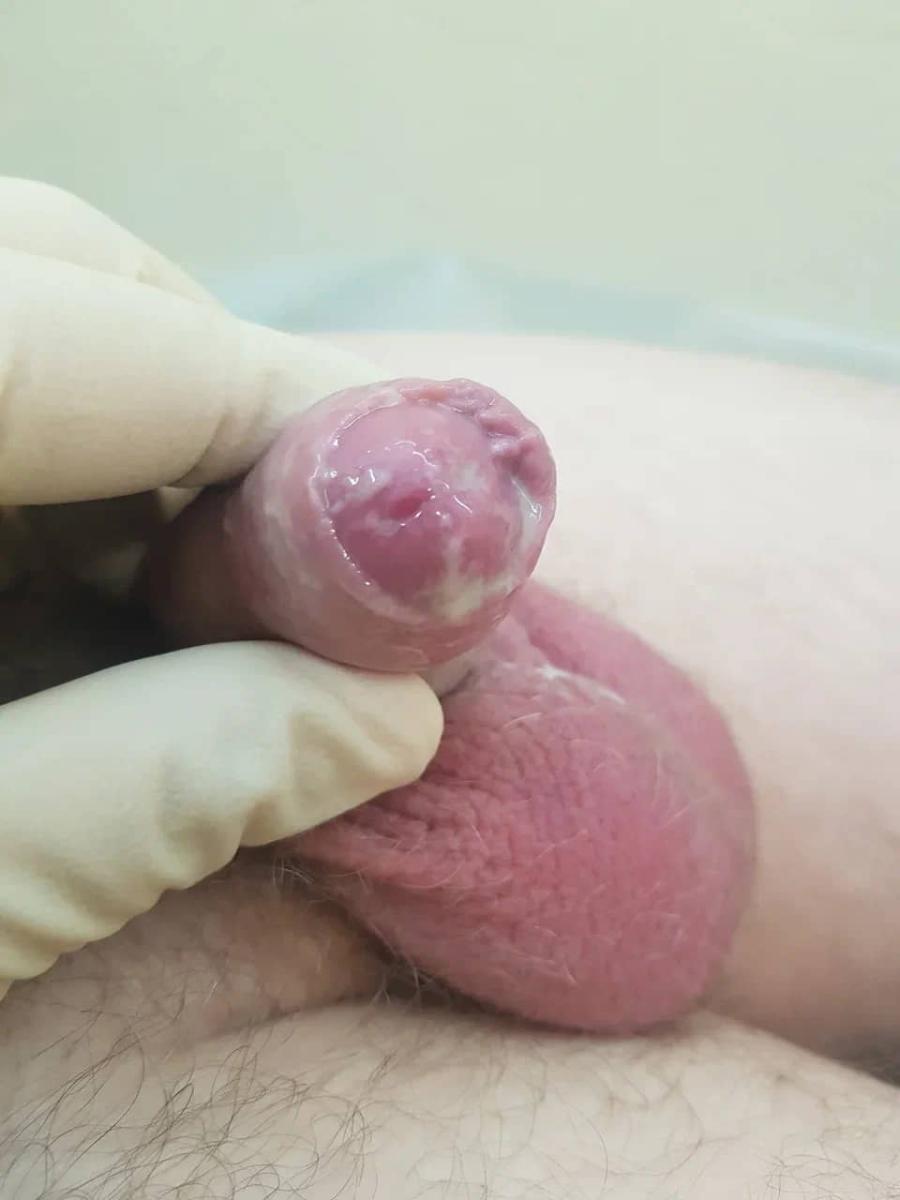 трихомониаз