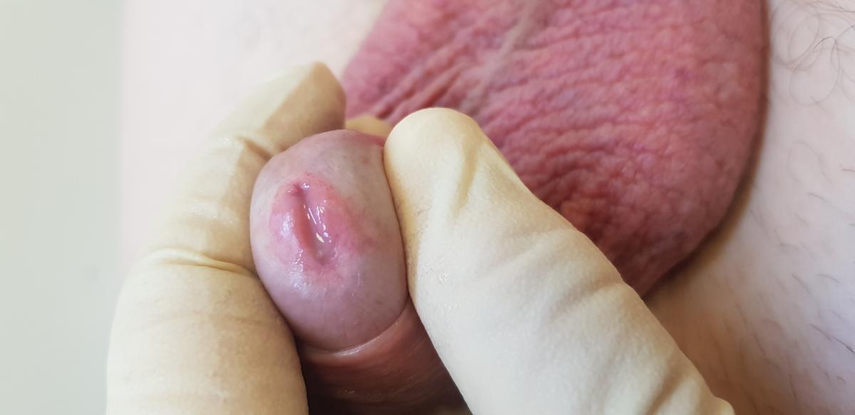 признаки микоплазма гениталиум признаки микоплазмоза