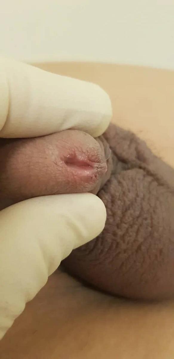 гонорея и лимфангит после лечения