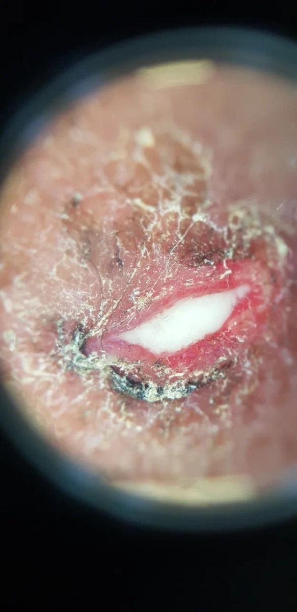 хламидия трахоматис возбудитель хламидиоза