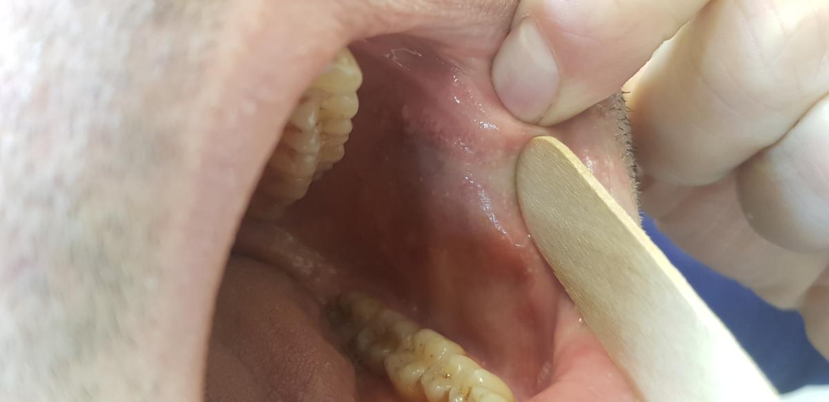 гранулы фордайса во рту Гранулы фордайса