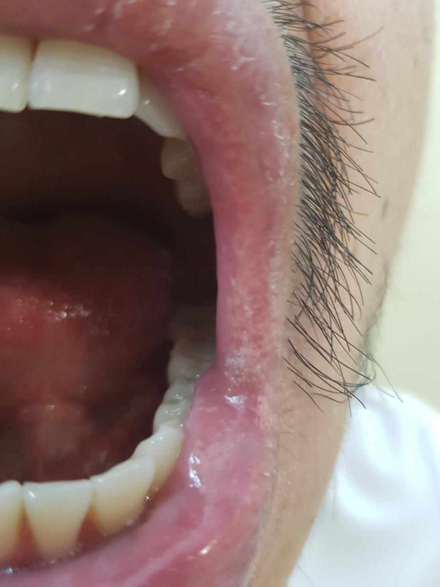 фото гранулы фордайса в углу губ