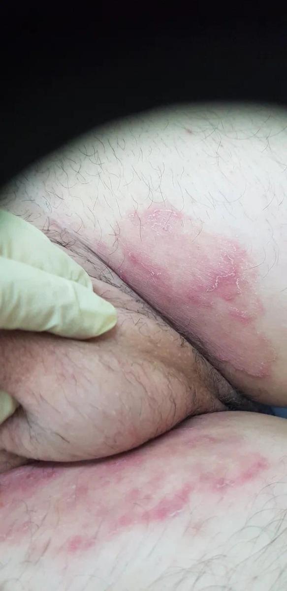 грибковое высыпание на половых органах