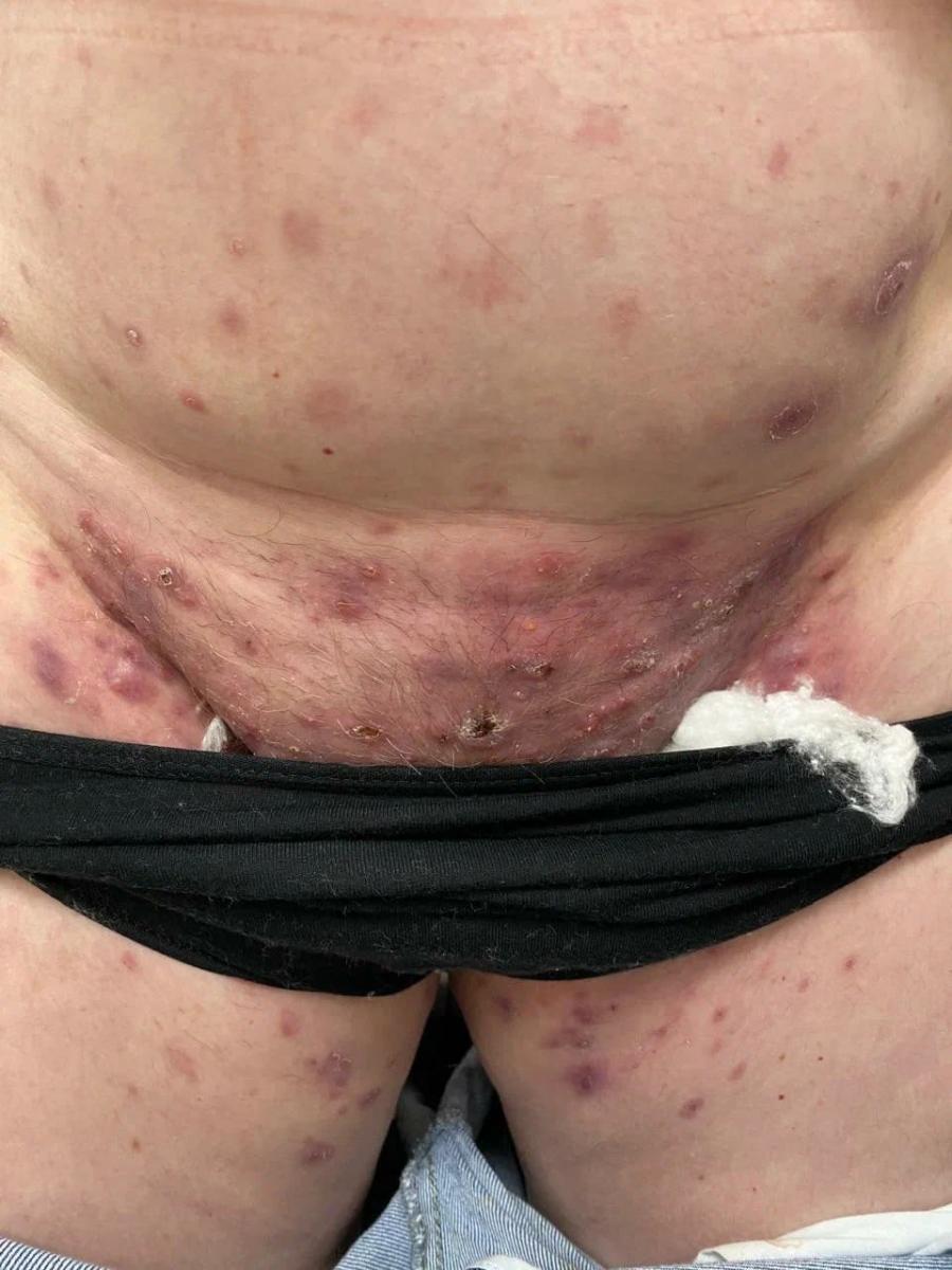 грибковые поражения 