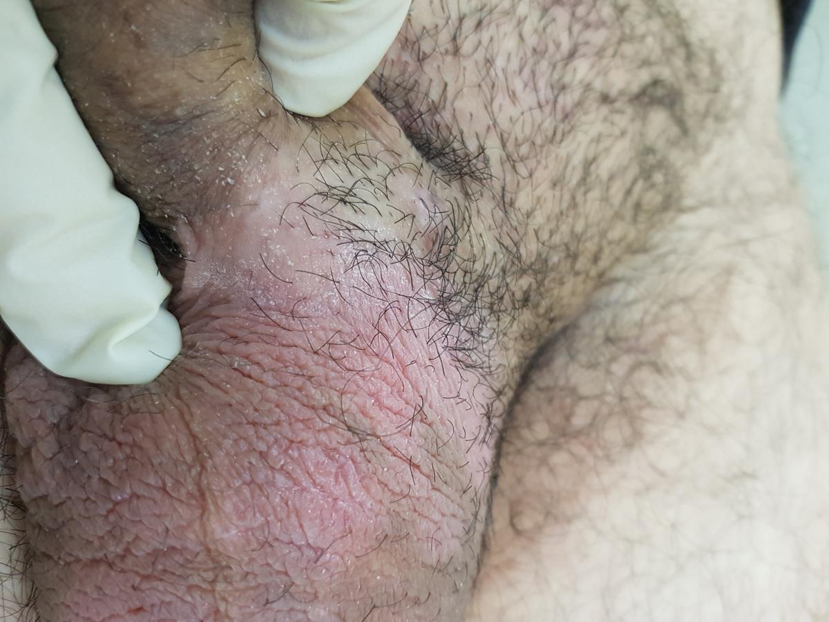 грибок на мошонке грибок на мошонке