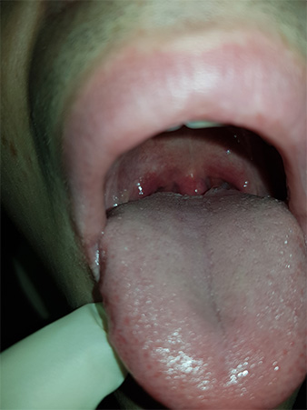 Хламидиоз горла и болезненность в суставах
