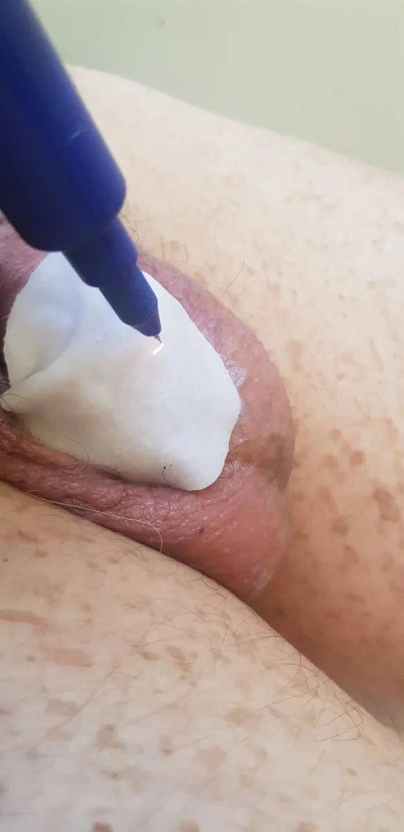 Обработка высыпаний холодной плазмой