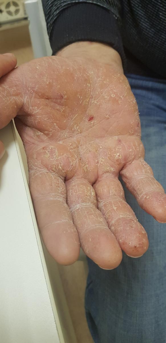 эпидермальная гиперплазия сифилитический гиперкератоз