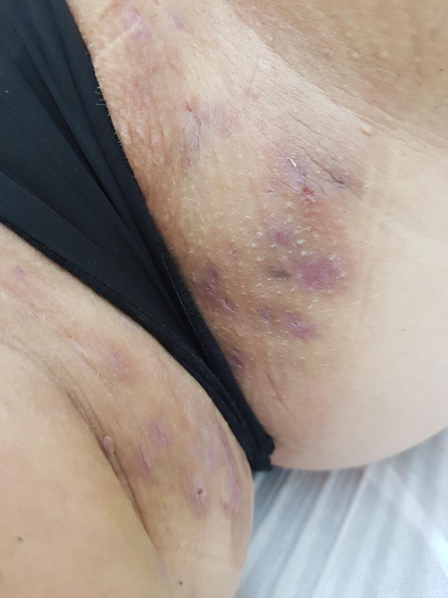 Воспаление потовых желез