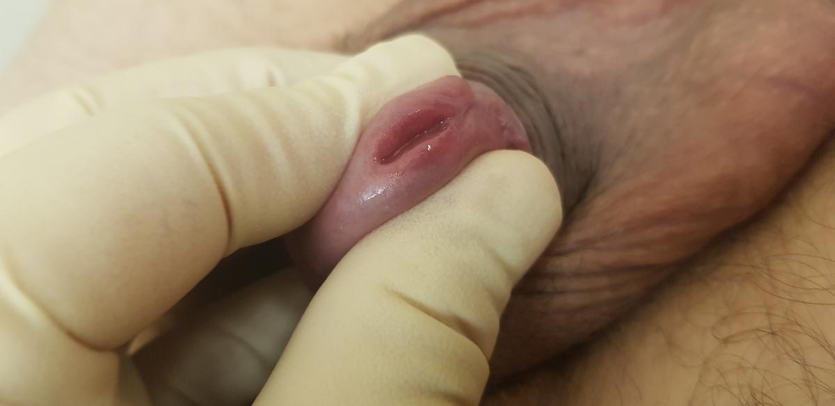 Хронический хламидиоз после доксициклина Хронический хламидиоз