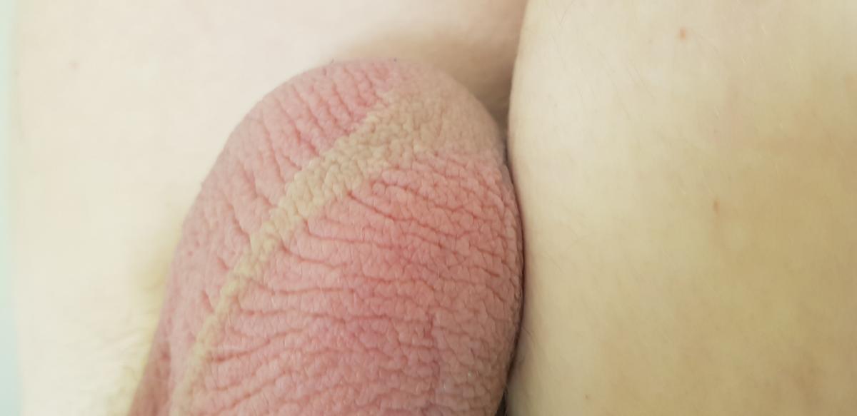 Сильный зуд мошонки