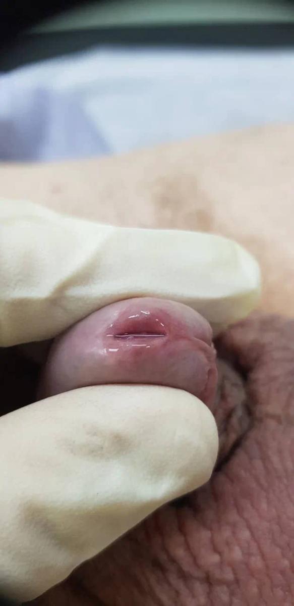 хронический уретрит