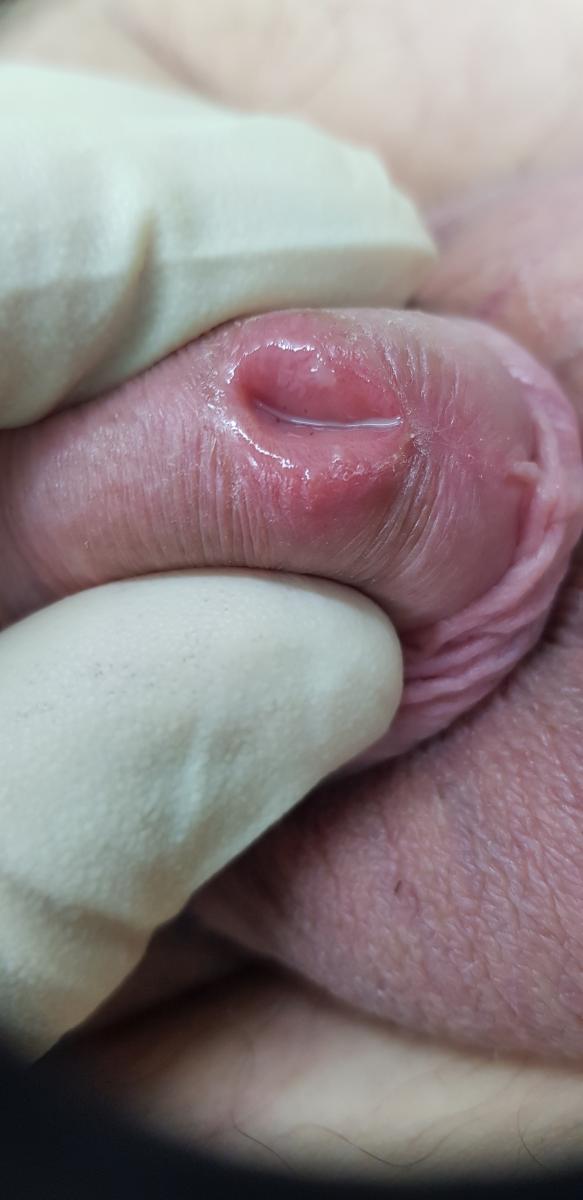 антитела к микоплазме иммуноглобулин А к микоплазме хоминис в крови