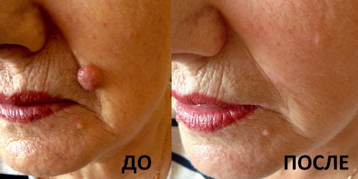 Бородавка на лице: до и после выжигания азтом