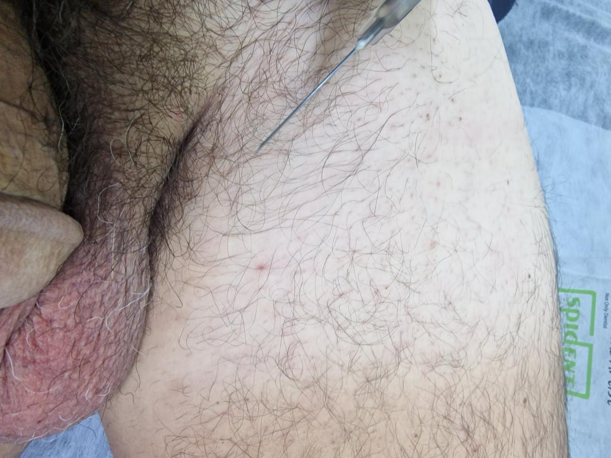 лимфйотропка