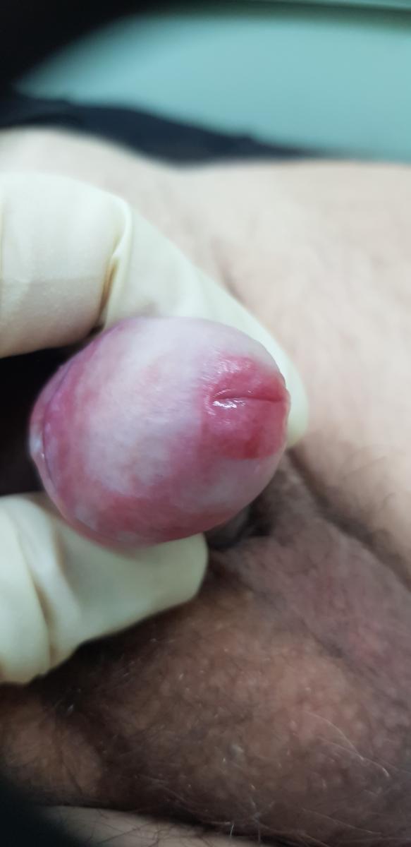 признаки хламидиоза у мужчин зуд