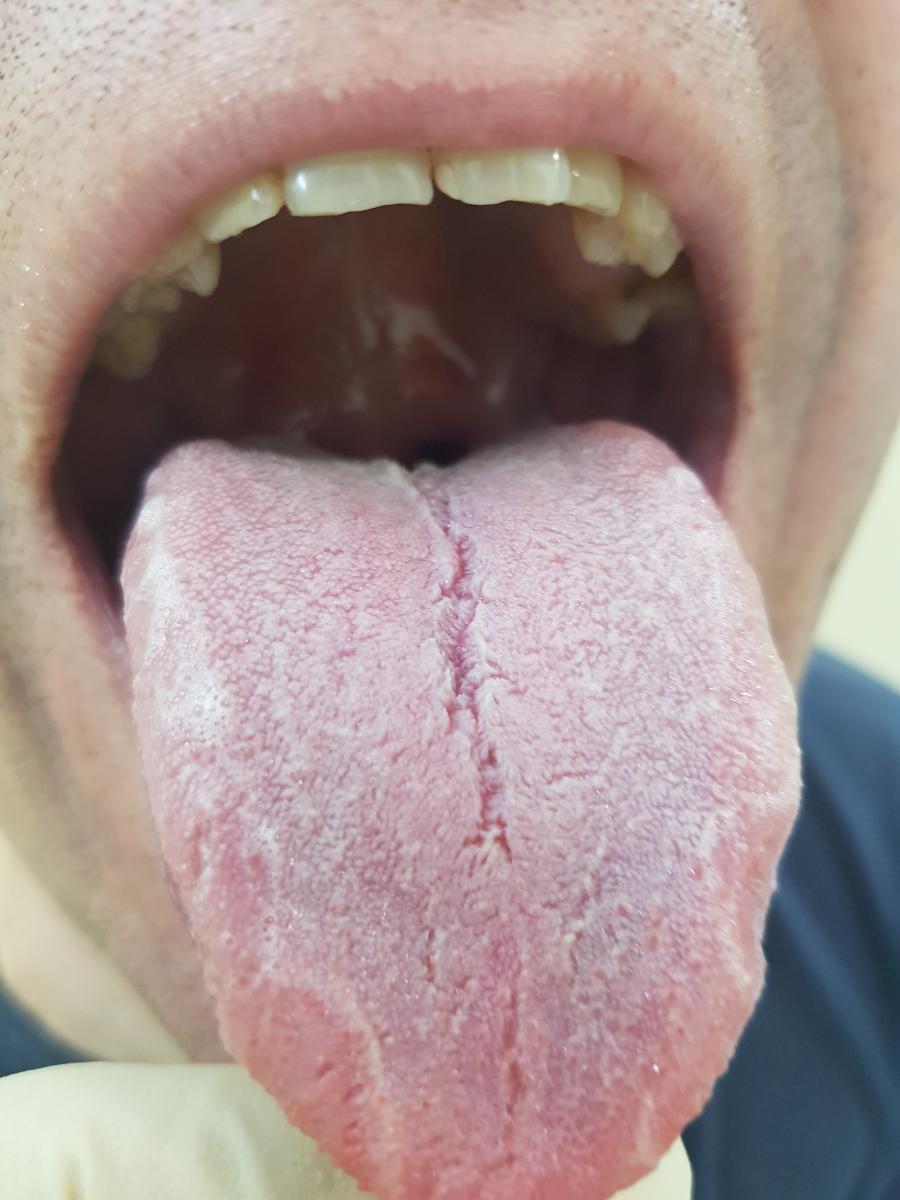 передача при оральном контакте Хламидия относится к ИППП