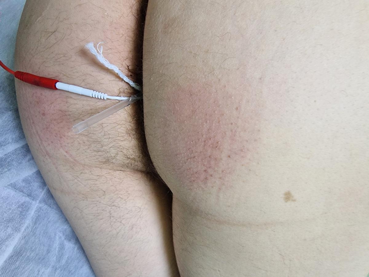 электрофорез